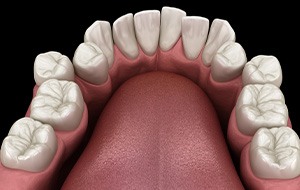 Illustration of crooked teeth