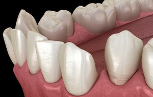 Illustration of gapped teeth