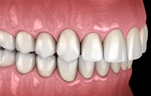 Illustration of an overbite