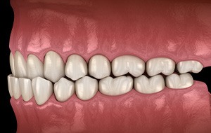 Illustration of an underbite