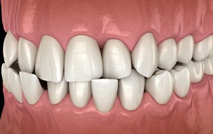 Illustration of a crossbite