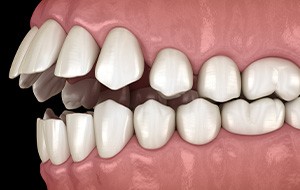 Illustration of an open bite