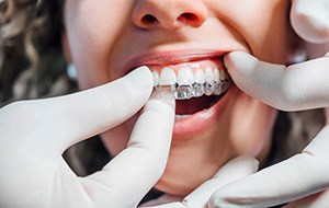 Dentist putting clear aligner on patient