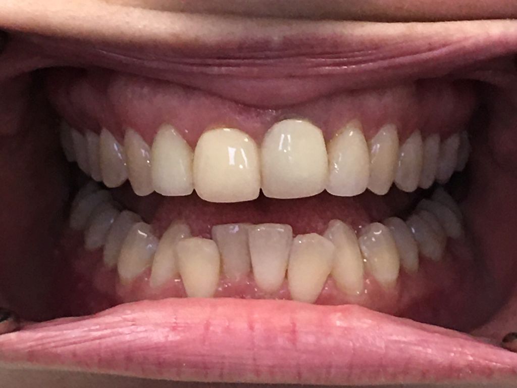 dental care kathryn mcilvain 11 anterior open bite1