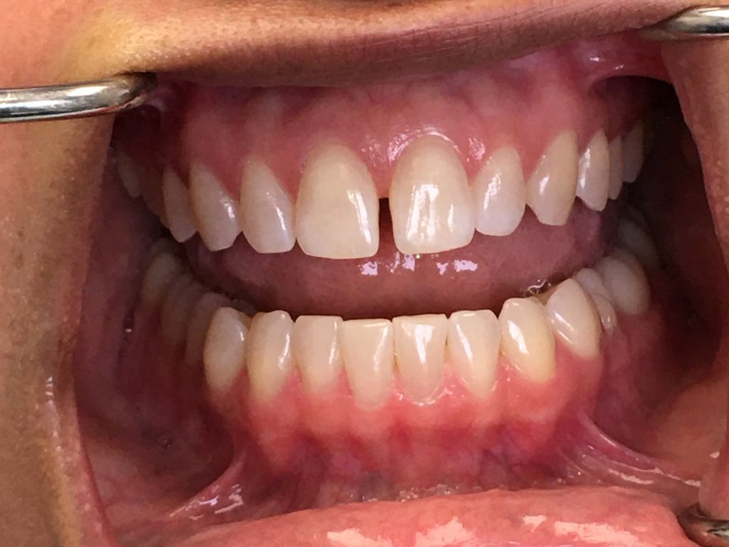 dental care melissa jacobson 11 anterior open bite1