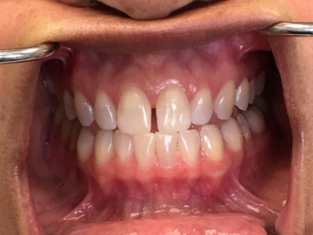 dental care melissa jacobson 8 anterior
