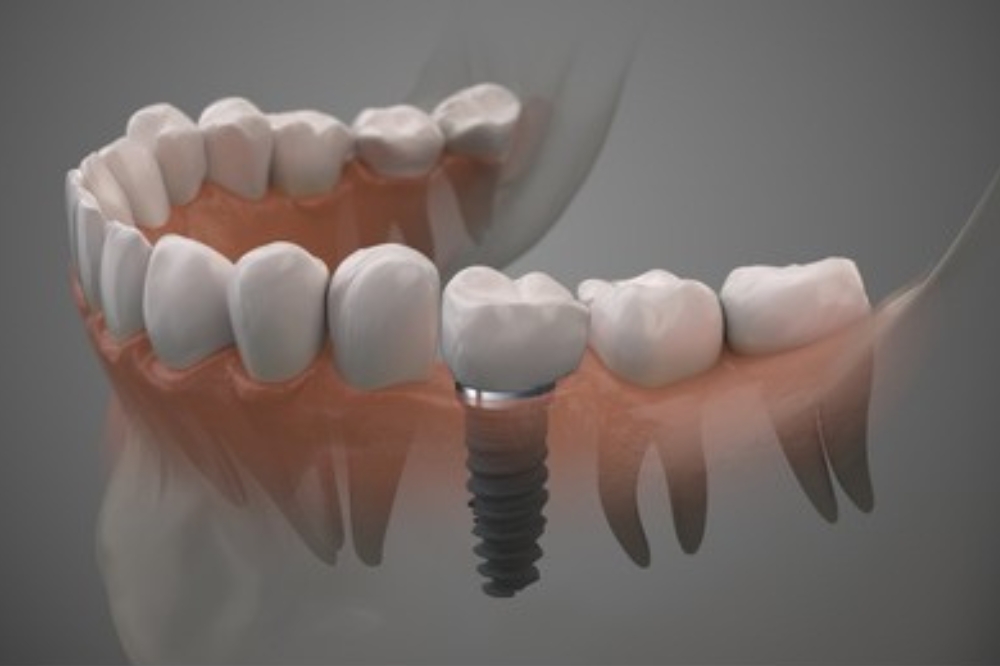 Missing A Tooth And Unsure What To Do? How Dental Implants Offer A Permanent Solution