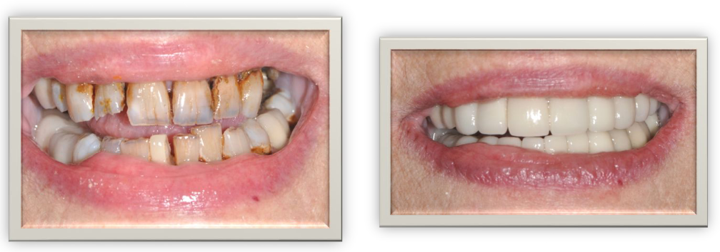 Smile transformation dental case 6
